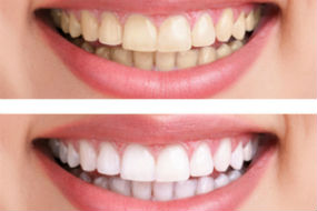 Teeth Whitening | Dr. Gallegos | Dentist Espanola, NM